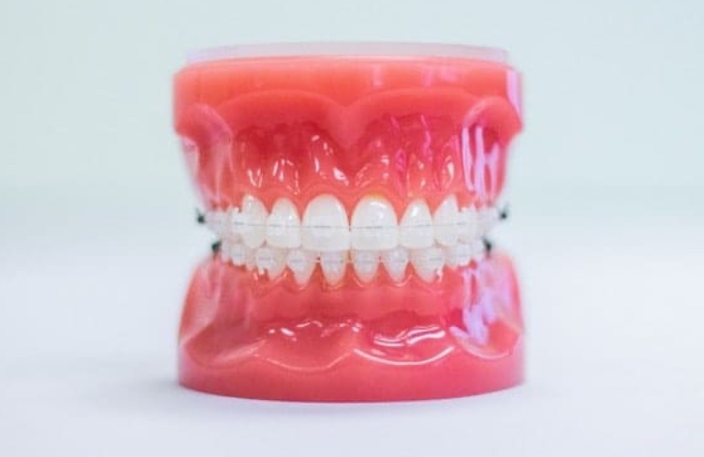 clear ceramic braces on plastic model