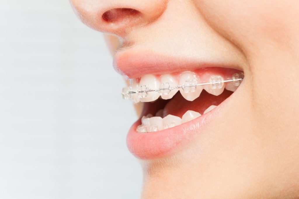 6 Myths About Braces Debunked